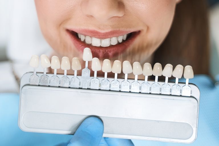 Cuidado de las carillas dentales - Clínica Dental Torres